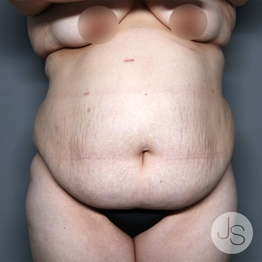 Mommy Makeover Before and After Pictures Beverly Hills, CA