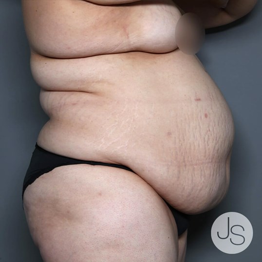 Tummy Tuck Before and After Pictures Beverly Hills, CA