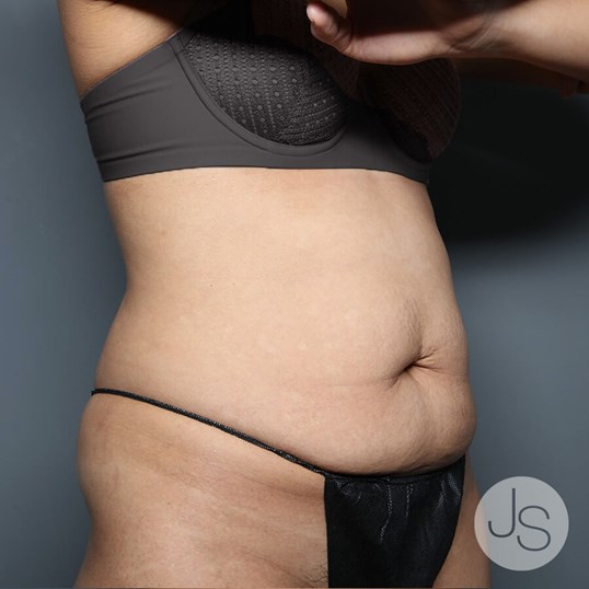 Tummy Tuck Before and After Pictures Beverly Hills, CA