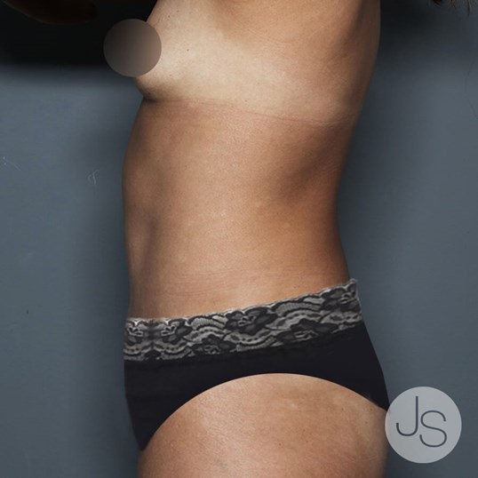 Tummy Tuck Before and After Pictures Beverly Hills, CA