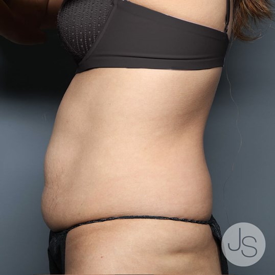 Tummy Tuck Before and After Pictures Beverly Hills, CA