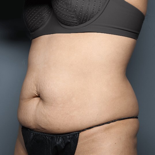 Tummy Tuck Before and After Pictures Beverly Hills, CA