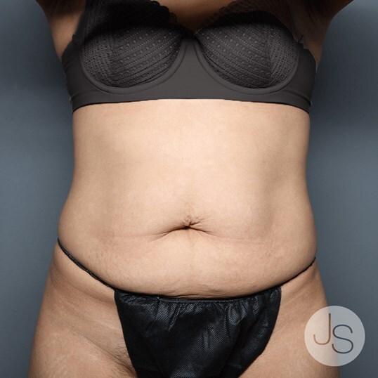 Tummy Tuck Before and After Pictures Beverly Hills, CA