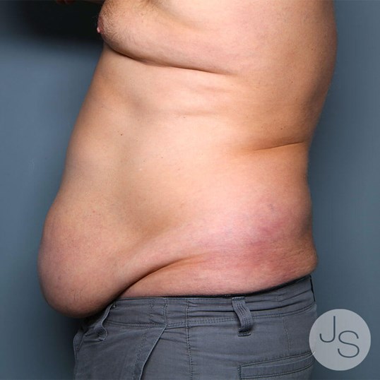 Tummy Tuck Before and After Pictures Beverly Hills, CA