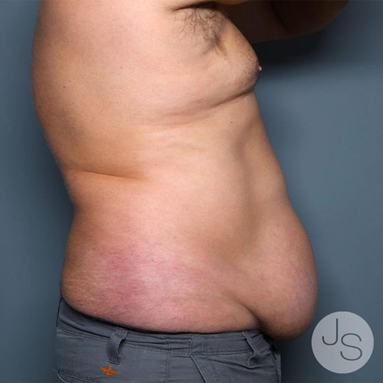 Tummy Tuck Before and After Pictures Beverly Hills, CA