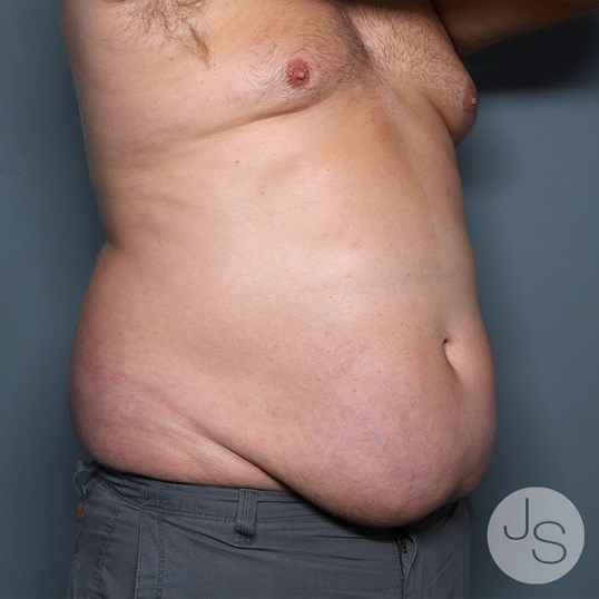 Tummy Tuck Before and After Pictures Beverly Hills, CA