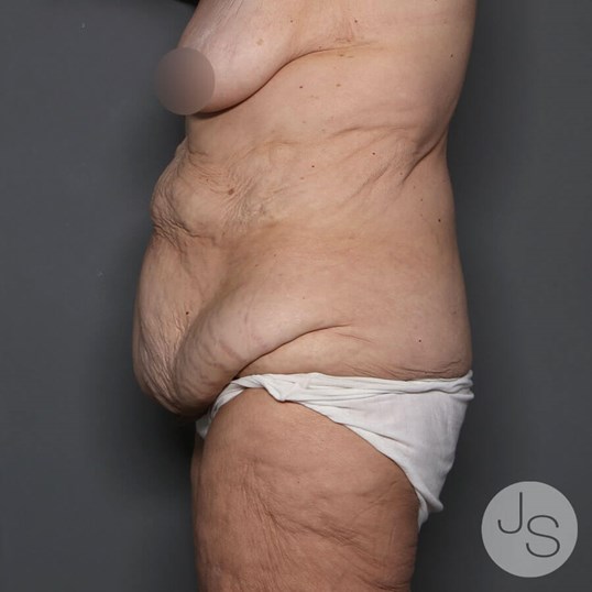 Tummy Tuck Before and After Pictures Beverly Hills, CA