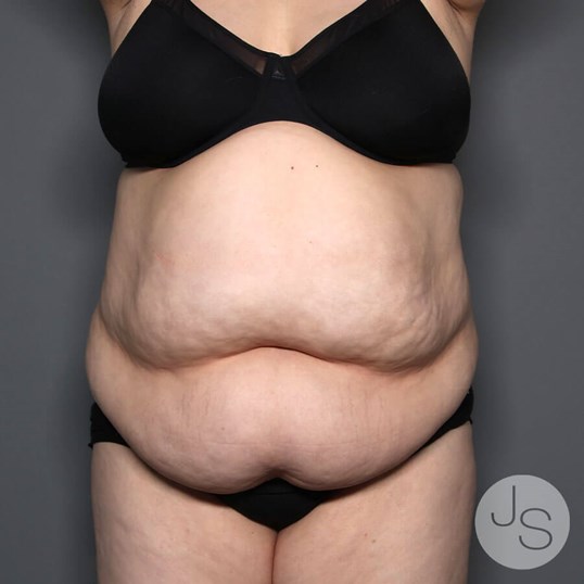 Tummy Tuck Before and After Pictures Beverly Hills, CA