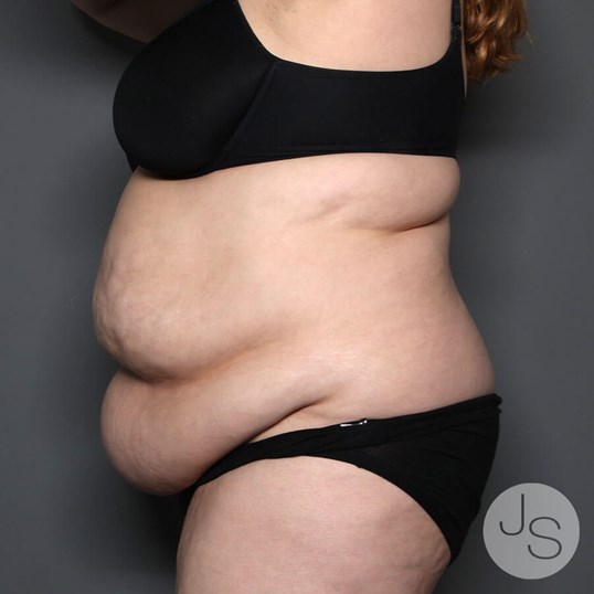 Tummy Tuck Before and After Pictures Beverly Hills, CA