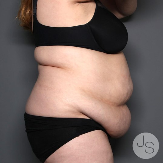 Tummy Tuck Before and After Pictures Beverly Hills, CA