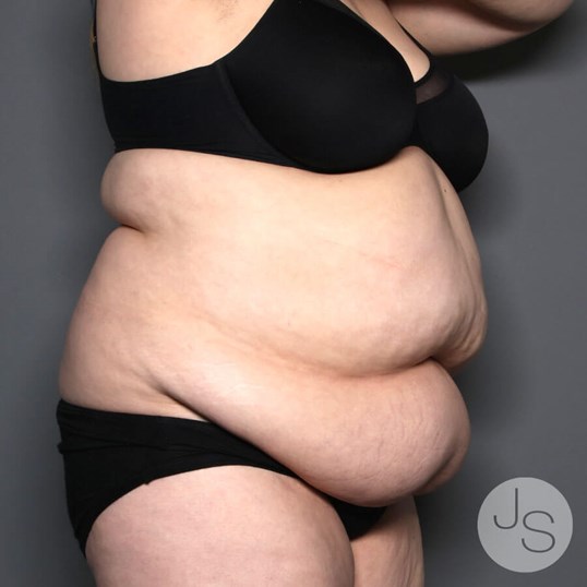 Tummy Tuck Before and After Pictures Beverly Hills, CA