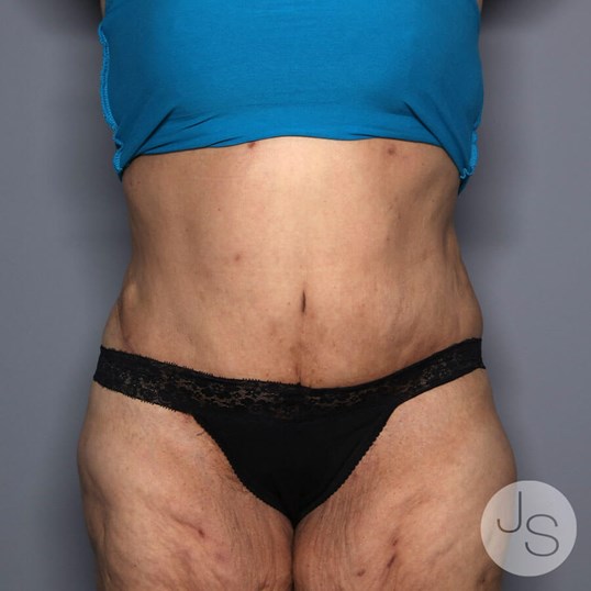 Tummy Tuck Before and After Pictures Beverly Hills, CA