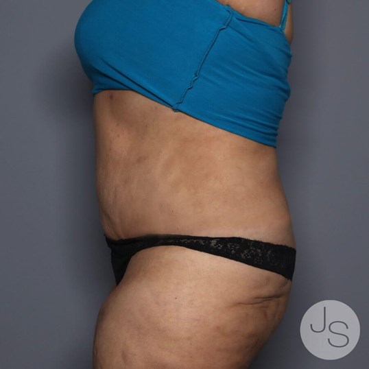 Tummy Tuck Before and After Pictures Beverly Hills, CA