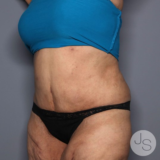 Tummy Tuck Before and After Pictures Beverly Hills, CA