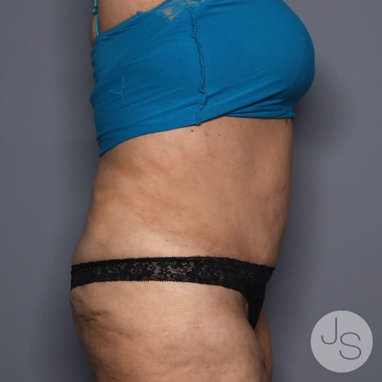 Tummy Tuck Before and After Pictures Beverly Hills, CA