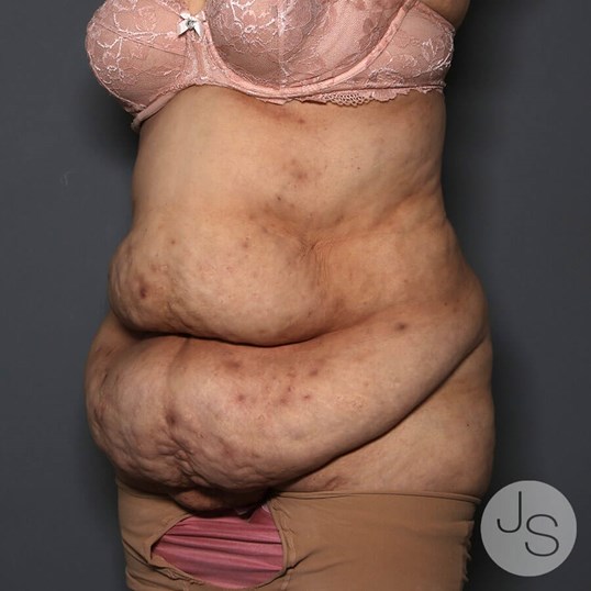 Tummy Tuck Before and After Pictures Beverly Hills, CA