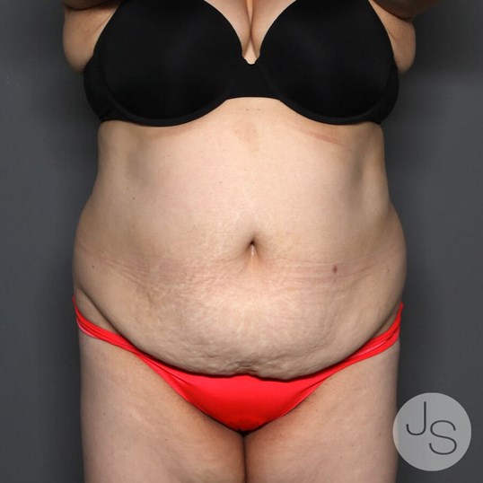 Tummy Tuck Before and After Pictures Beverly Hills, CA