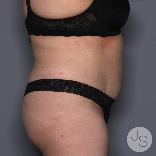 Tummy Tuck Before and After Pictures Beverly Hills, CA