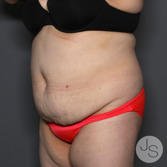 Tummy Tuck Before and After Pictures Beverly Hills, CA