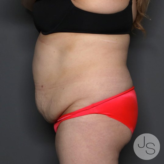 Tummy Tuck Before and After Pictures Beverly Hills, CA