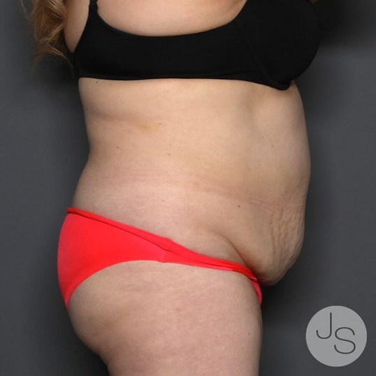 Tummy Tuck Before and After Pictures Beverly Hills, CA