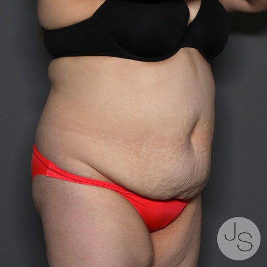 Tummy Tuck Before and After Pictures Beverly Hills, CA