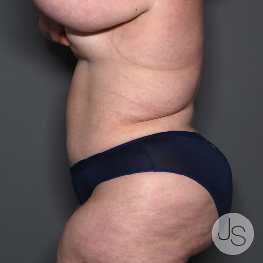 Tummy Tuck Before and After Pictures Beverly Hills, CA