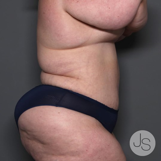 Tummy Tuck Before and After Pictures Beverly Hills, CA