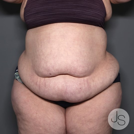 Tummy Tuck Before and After Pictures Beverly Hills, CA