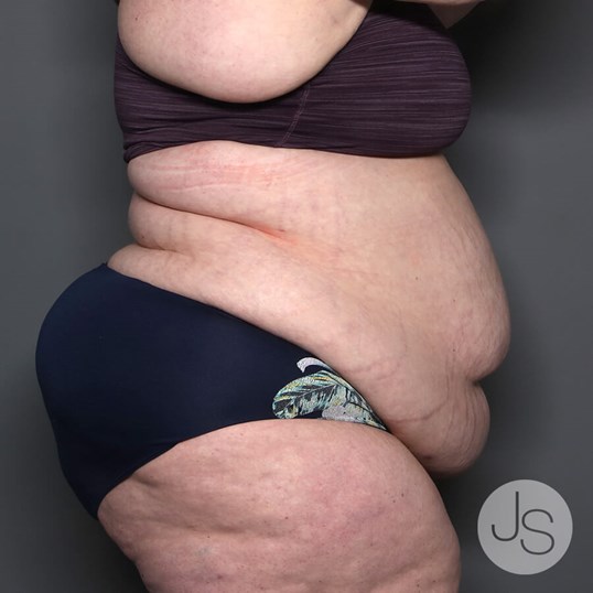 Tummy Tuck Before and After Pictures Beverly Hills, CA