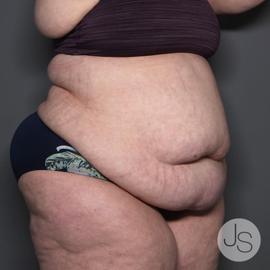 Tummy Tuck Before and After Pictures Beverly Hills, CA