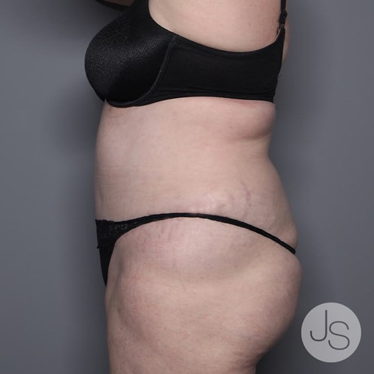 Tummy Tuck Before and After Pictures Beverly Hills, CA