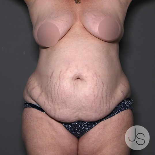 Tummy Tuck Before and After Pictures Beverly Hills, CA