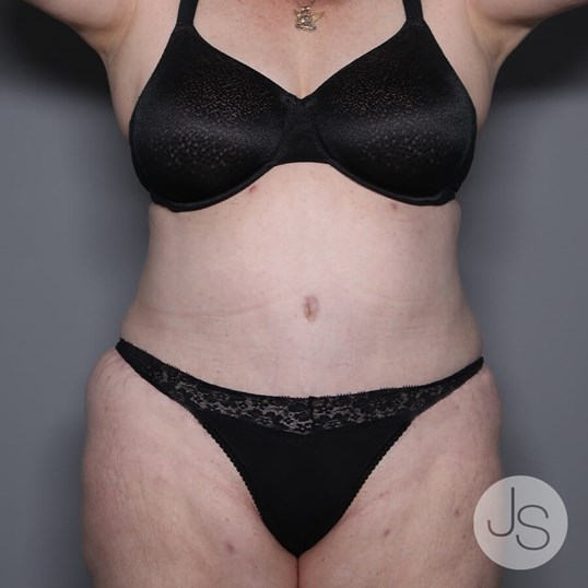 Tummy Tuck Before and After Pictures Beverly Hills, CA