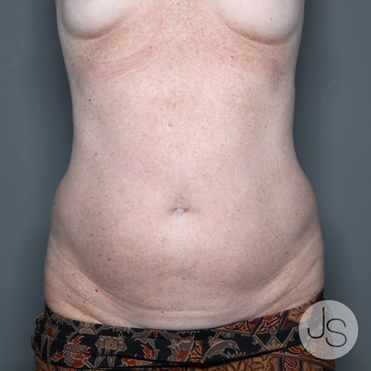 Tummy Tuck Before and After Pictures Beverly Hills, CA