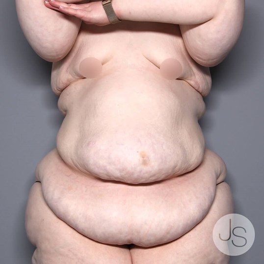 Tummy Tuck Before and After Pictures Beverly Hills, CA