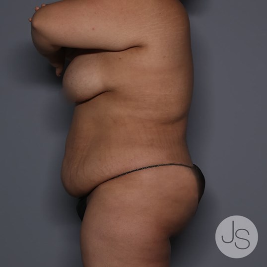 Tummy Tuck Before and After Pictures Beverly Hills, CA