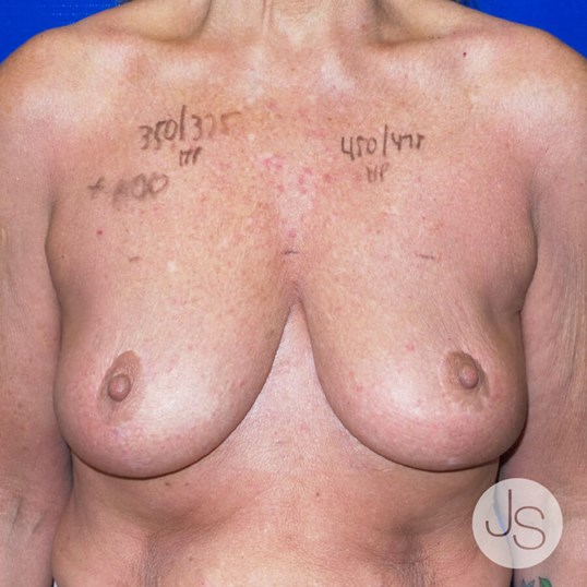 Scars and Treatments Before and After Pictures Beverly Hills, CA