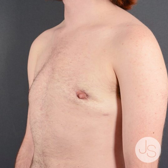 FTM Top Surgery Before and After Pictures Beverly Hills, CA