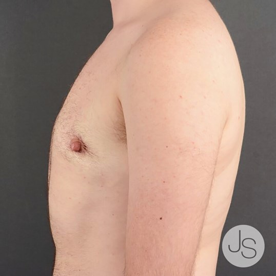 FTM Top Surgery Before and After Pictures Beverly Hills, CA