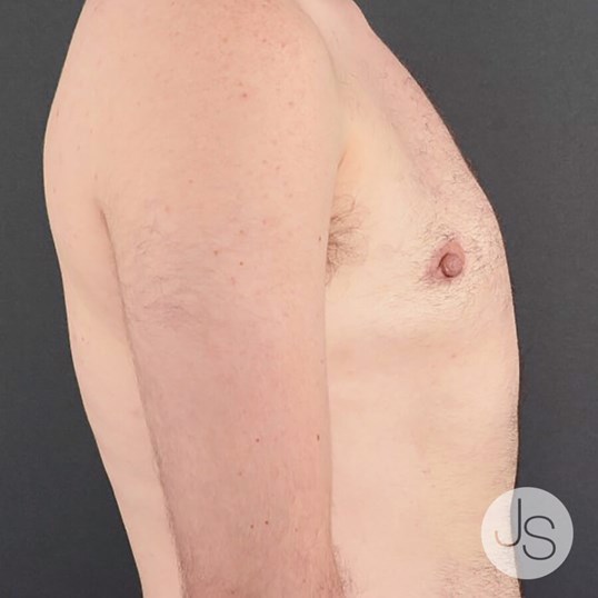 FTM Top Surgery Before and After Pictures Beverly Hills, CA