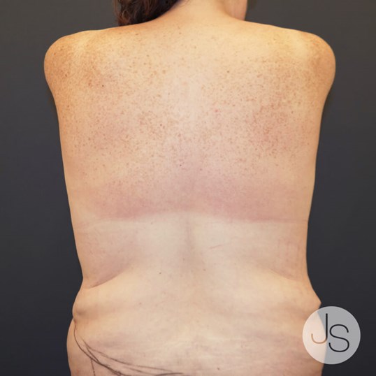 Bra Line Back Lift Signature Procedures Pictures