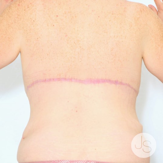 Bra Line Back Lift Before and After Pictures Beverly Hills, CA