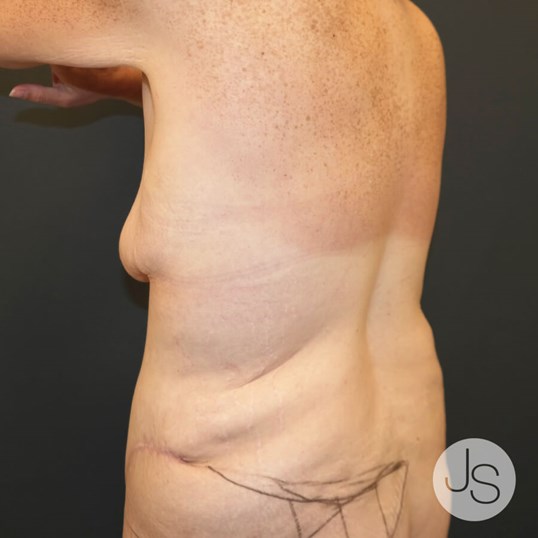 How An Upper Tummy Tuck and Bra Line Back Lift Can Reshape Your Upper Body  - Jaime Schwartz MD, FACS