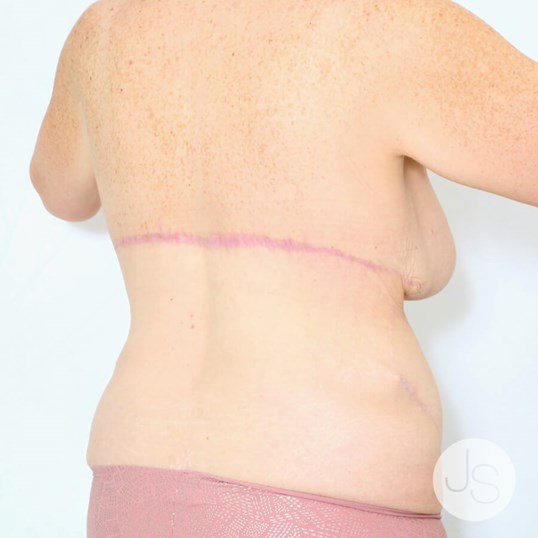 Bra Line Back Lift Before & After Photos Patient 1001680