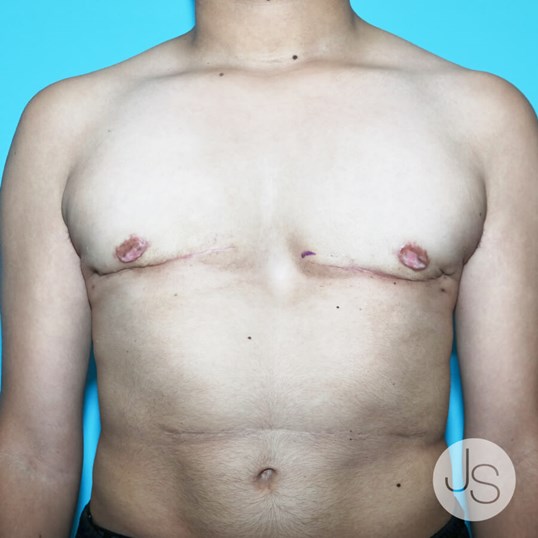 Gynecomastia Before and After Pictures Beverly Hills, CA