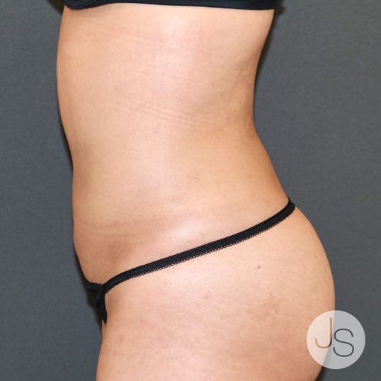 Fat Transfer and Injections Before and After Pictures Beverly Hills, CA