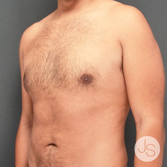 Gynecomastia Before and After Pictures Beverly Hills, CA
