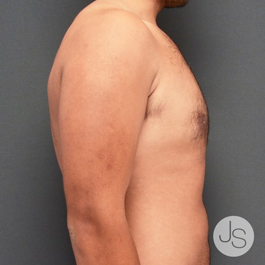 Gynecomastia Before and After Pictures Beverly Hills, CA