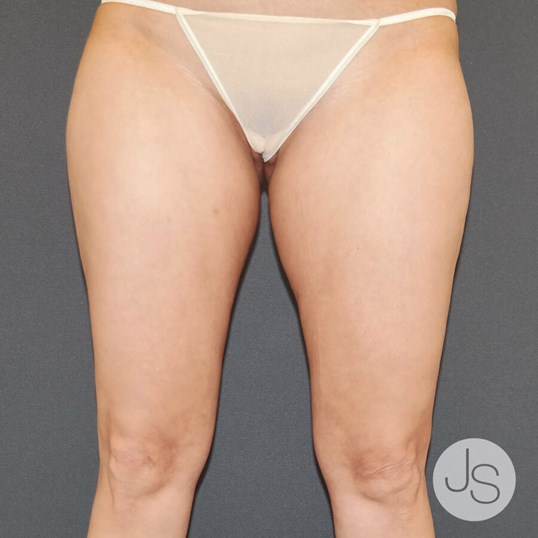 Thigh Lift Before and After Pictures Beverly Hills, CA